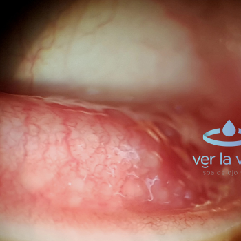 conjuntivitisalergica