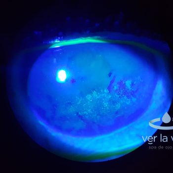 queratitis