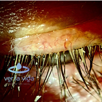 rosacea-ocular