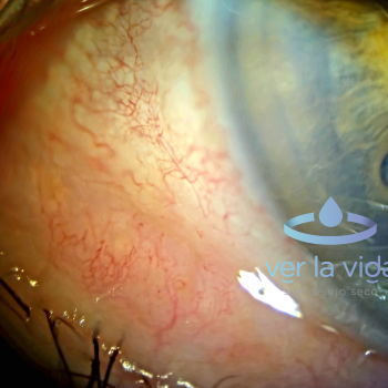 rosaceaocular (2)
